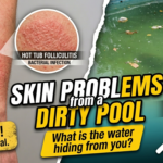 A split image showing a man scratching a red skin rash on his arm next to a neglected, green swimming pool with floating debris. Text overlays warn of "Skin Problems from a Dirty Pool" and highlight "Hot Tub Folliculitis" alongside icons for bacteria and fungi.